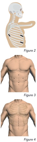 Figure 2,3,4 images of procedure