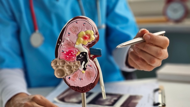 New Kidney Stone Treatment at MWH