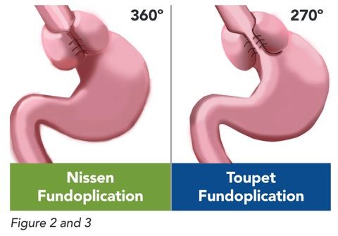 Stomach before and after