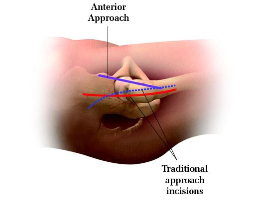 anterior approach