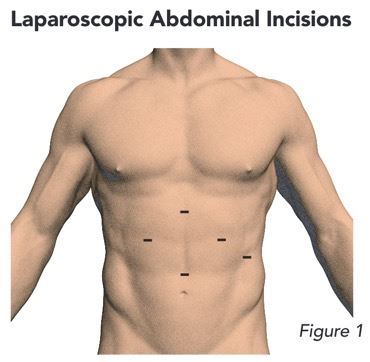 abdominal surgical incisions