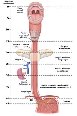 Esophogectomy fig 1