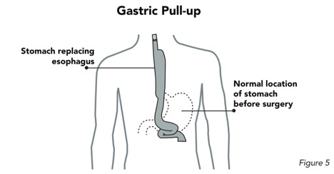 Gastric Pull up image