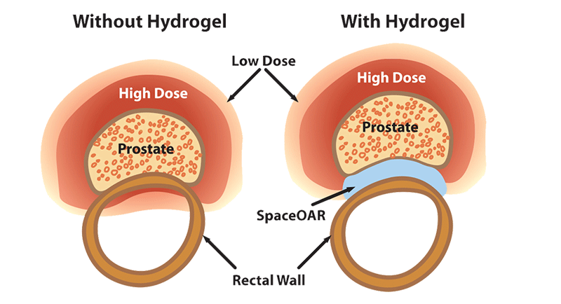 hydrogel