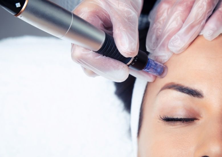picture of a provider performing microneedling on a patient's forehead