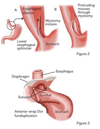 Myotomy