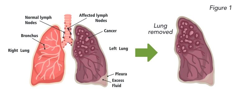 Lunch removal figure