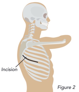 Figure 2 incision mark